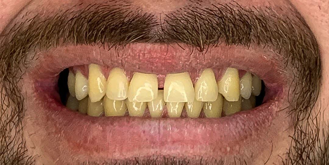 Antes do clareamento dental