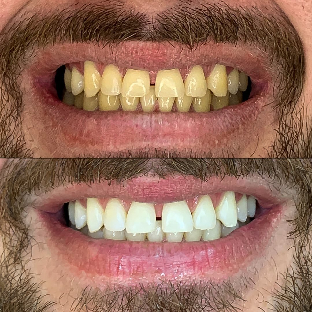 Clareamento dental