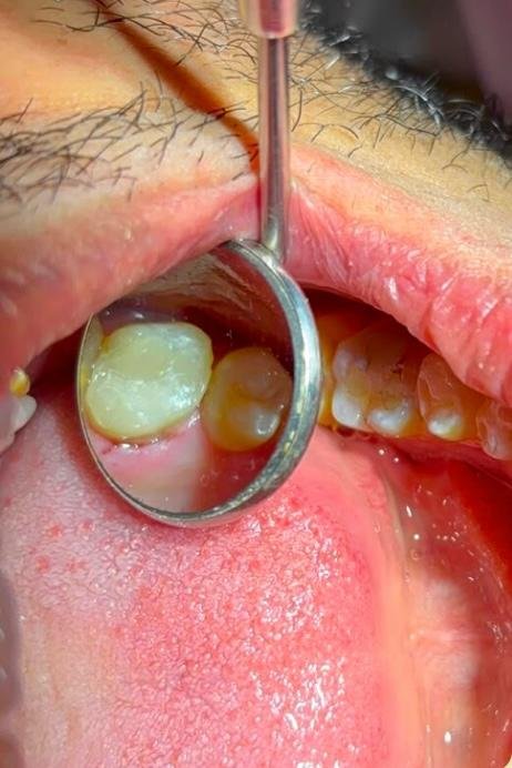 Restauração dental