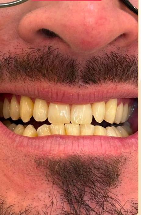 Antes do clareamento dental