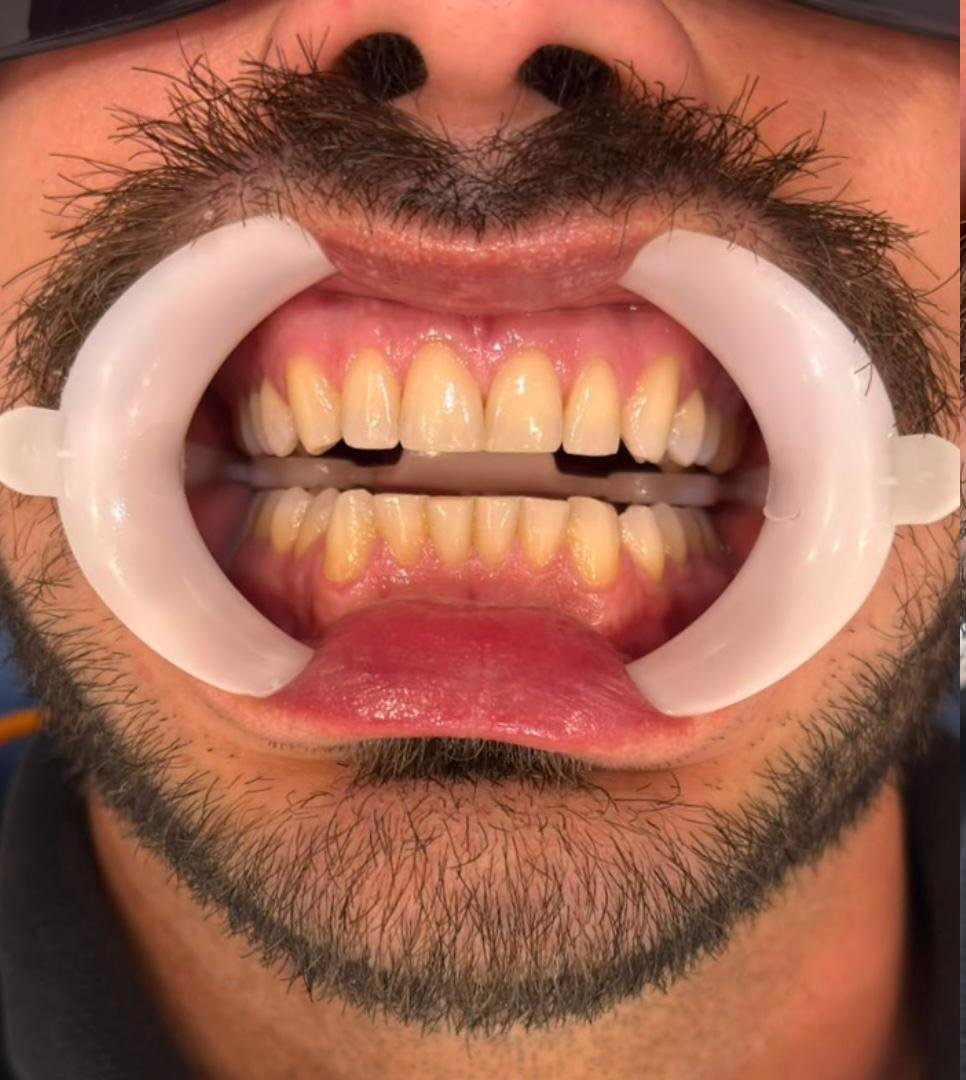 Antes do clareamento dental