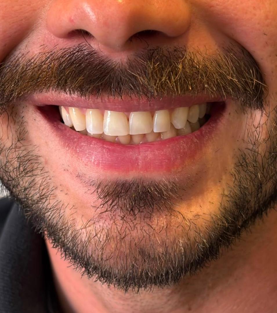Depois do clareamento dental