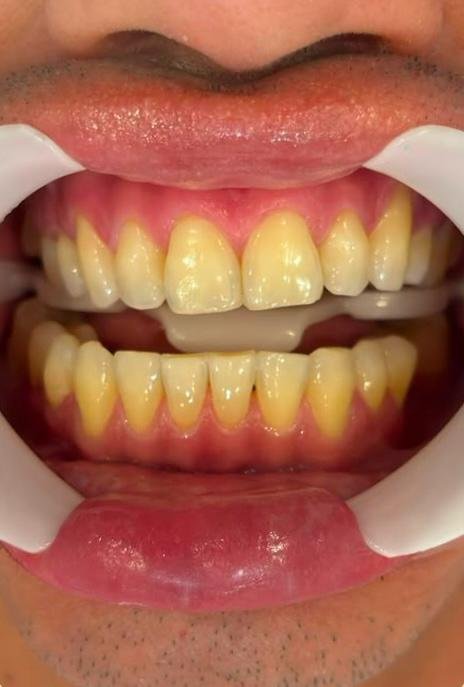Antes do clareamento dental