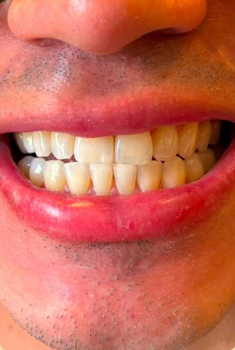Depois do clareamento dental