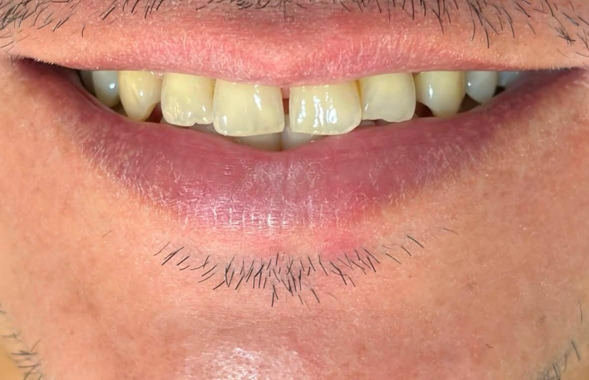 Antes do clareamento dental